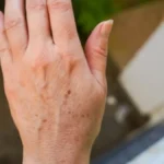 Imamo rešenje za fleke na rukama: Sami napravite domaću kremu od koje se koža preporodi