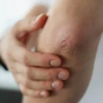 Ma ne možeš samo kremom, moraš malo i da paziš: Kako oživeti kožu na laktovima, evo šta će je omekšati