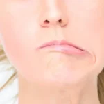 Žena se paralisala za nekoliko dana: Mislila je da ima upalu uva i ignorisala simptome