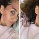 Ivana Dudić sva u modricama: Osvanule fotorgafije povređene glumice
