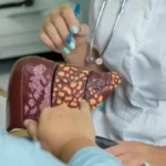 Samo ove namirnice i ima lipidni status da vam bude top: Evo je dijeta za masnu jetru, ovu hranu teba da jedete