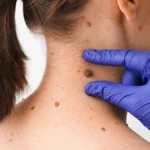 Mladež menja boju, krvari ili svrbi? Doktorka upozorava: Ovo su znaci da odmah morate kod dermatologa