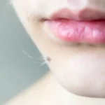 Raste vam dlaka iz mladeža? Evo da li sme da se čupa