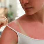 Koža mi se spržila na suncu: Namažem ovu mešavinu i opekotine nestanu do jutra!