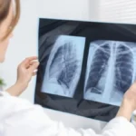 Bolest pluća ne počinje uvek kašljem: 4 rana simptoma koja mnogi zanemaruju